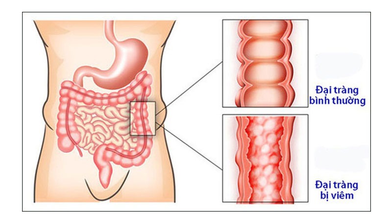 Viêm đại tràng là gì? Cách chữa viêm đại tràng, ngăn ngừa tái phát