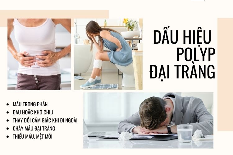 Dấu hiệu polyp đại tràng sigma