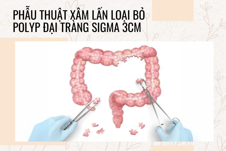 Phẫu thuật xâm lấn là cách loại bỏ polyp đại tràng sigma 3cm