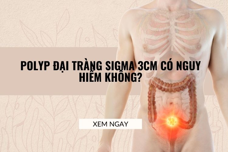 Polyp đại tràng sigma 3cm có nguy hiểm không? Nguyên nhân và triệu chứng